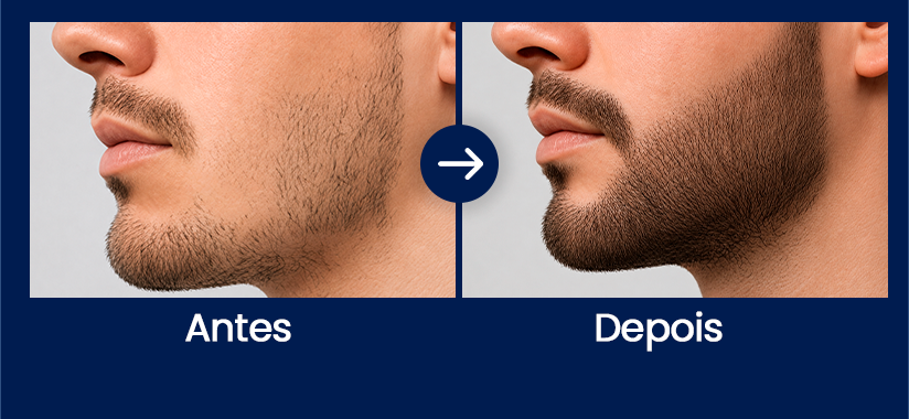 antes-e-depois-colorido Transplante de Barba