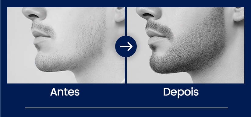 antes-e-depois Transplante de Barba