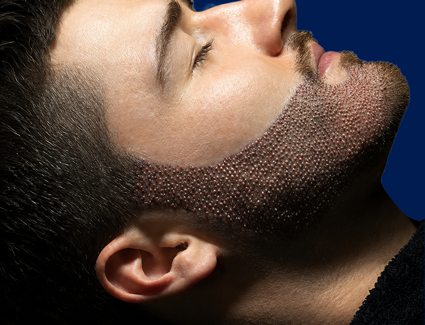 homem-deitado Transplante de Barba